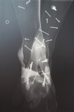Radiografía (pies) tomada para la restauración